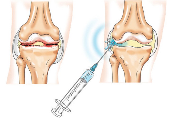Как вылечить коленный сустав при остеопорозе thumbnail