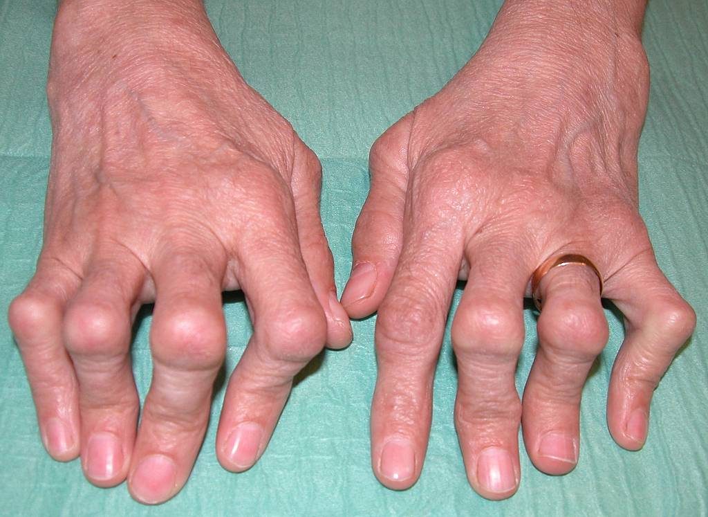 Ревматоидный артрит лечение чистотелом thumbnail