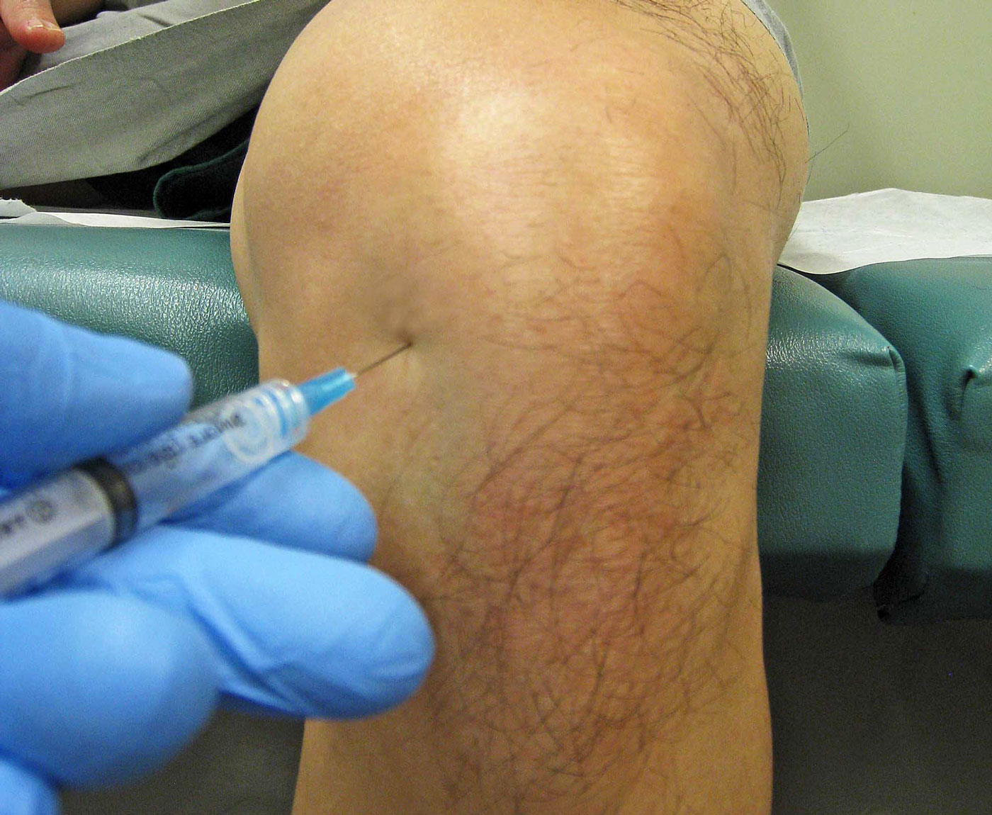 Уколы в коленный сустав при артрозе препараты