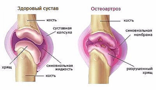 Остеоартроз плеча схема