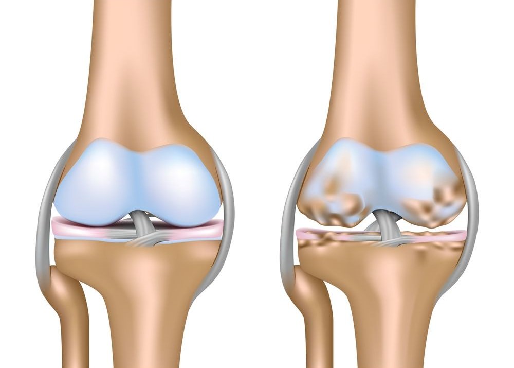 Изображение - Диагноз коленного сустава доа 2 степени arthrosis_of_the_knee_joint