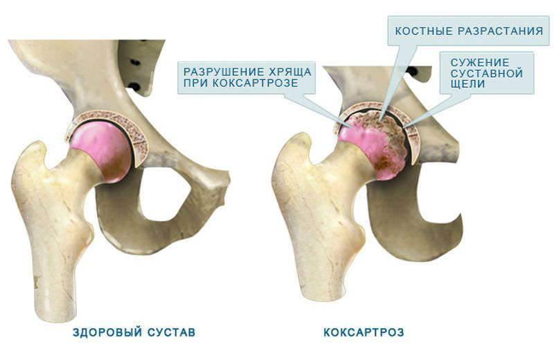 Изображение - Боль в суставе бедра к какому врачу bol-v-tazobedrennom-sustave3