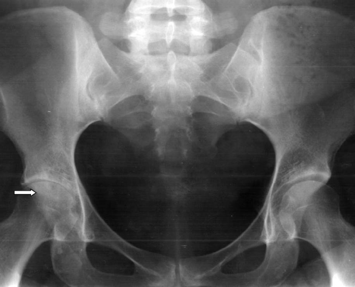 Рентген перейтройки головки бедренной кости