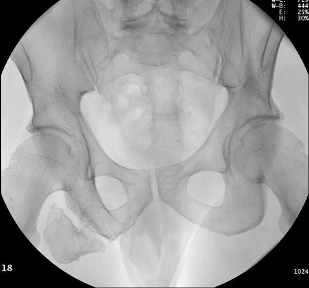 Рентген повреждения седалищного бугра