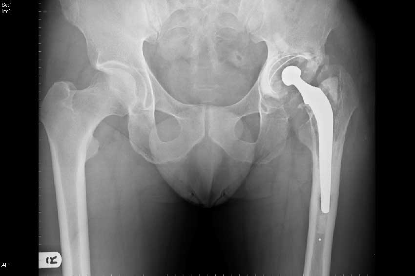 Рентген протеза тазобедренного сустава