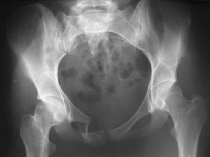 Рентген перелома лонной кости