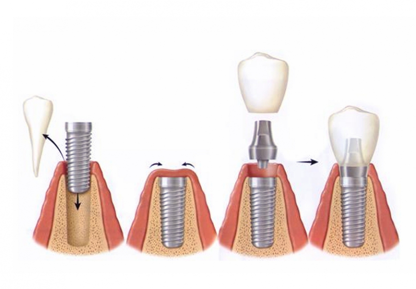 Имплантация зубов: показания, методы и виды
