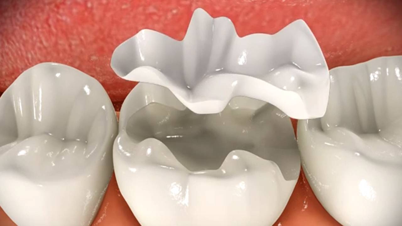 Что такое керамические вкладки на зубы?
