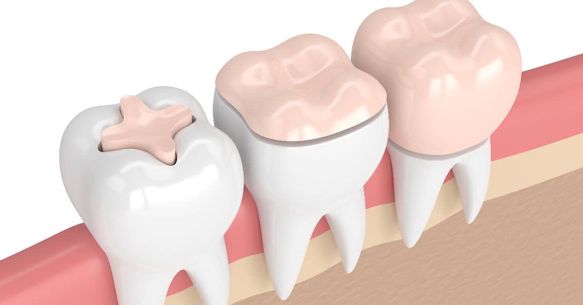 Что такое керамические вкладки на зубы?