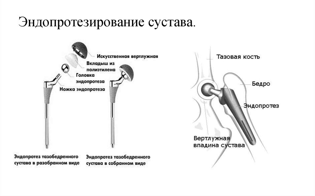 Подробное объяснение процедуры эндопротезирования тазобедренного сустава