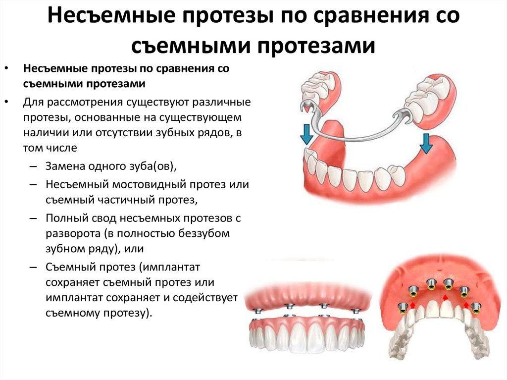 Методы протезирования зубов