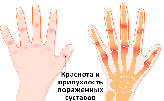 Лечение артрита пальцев рук: как вернуть комфорт своим рукам