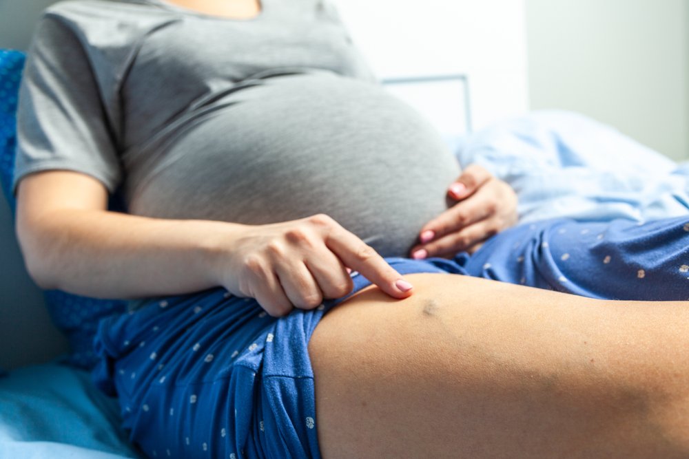 Варикозное расширение вен при беременности: возможные причины, симптомы и способы профилактики
